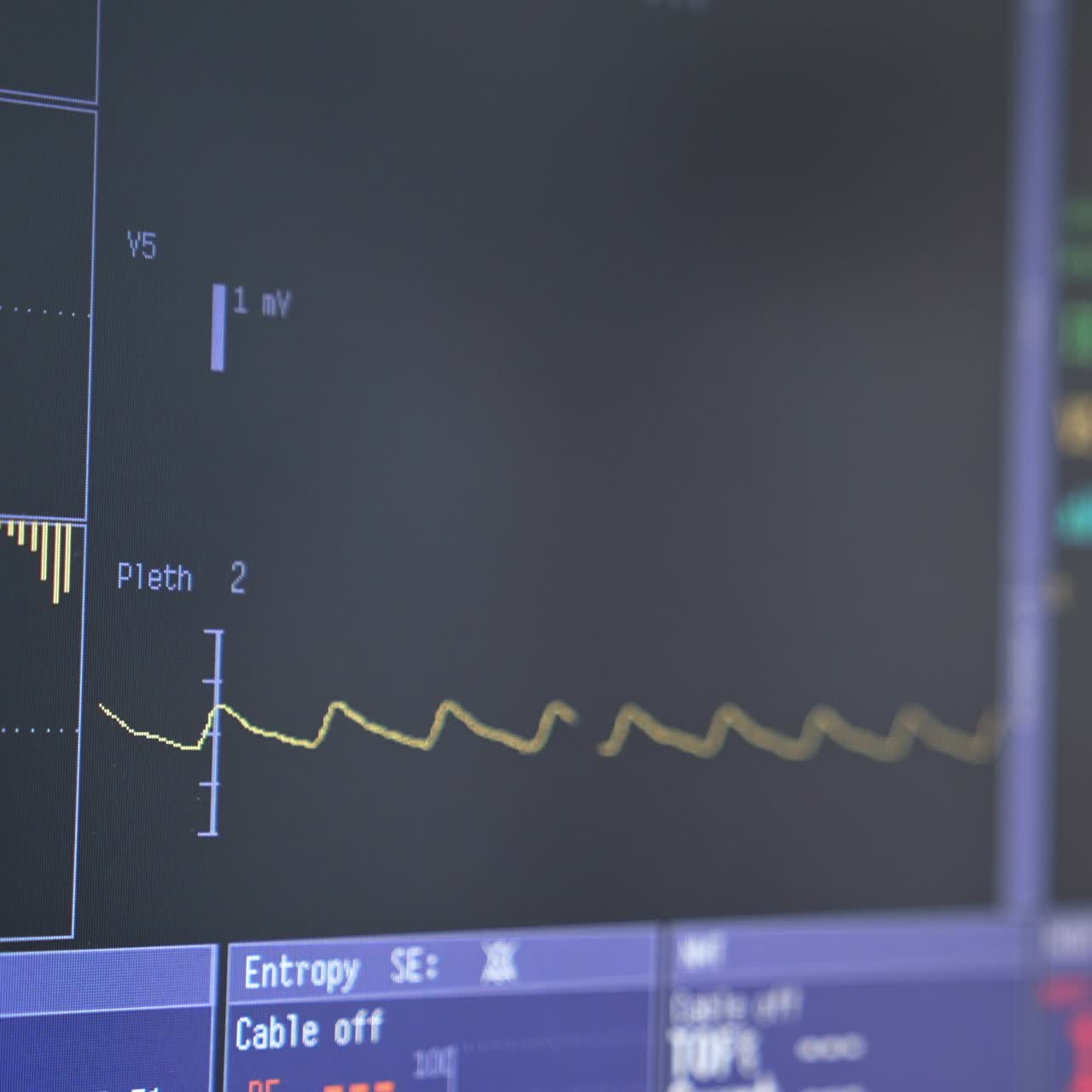 Screen of anesthesia surgery monitor. Vital signs of a patient showing heat beat rate during operation in intensive care unit. Close-up