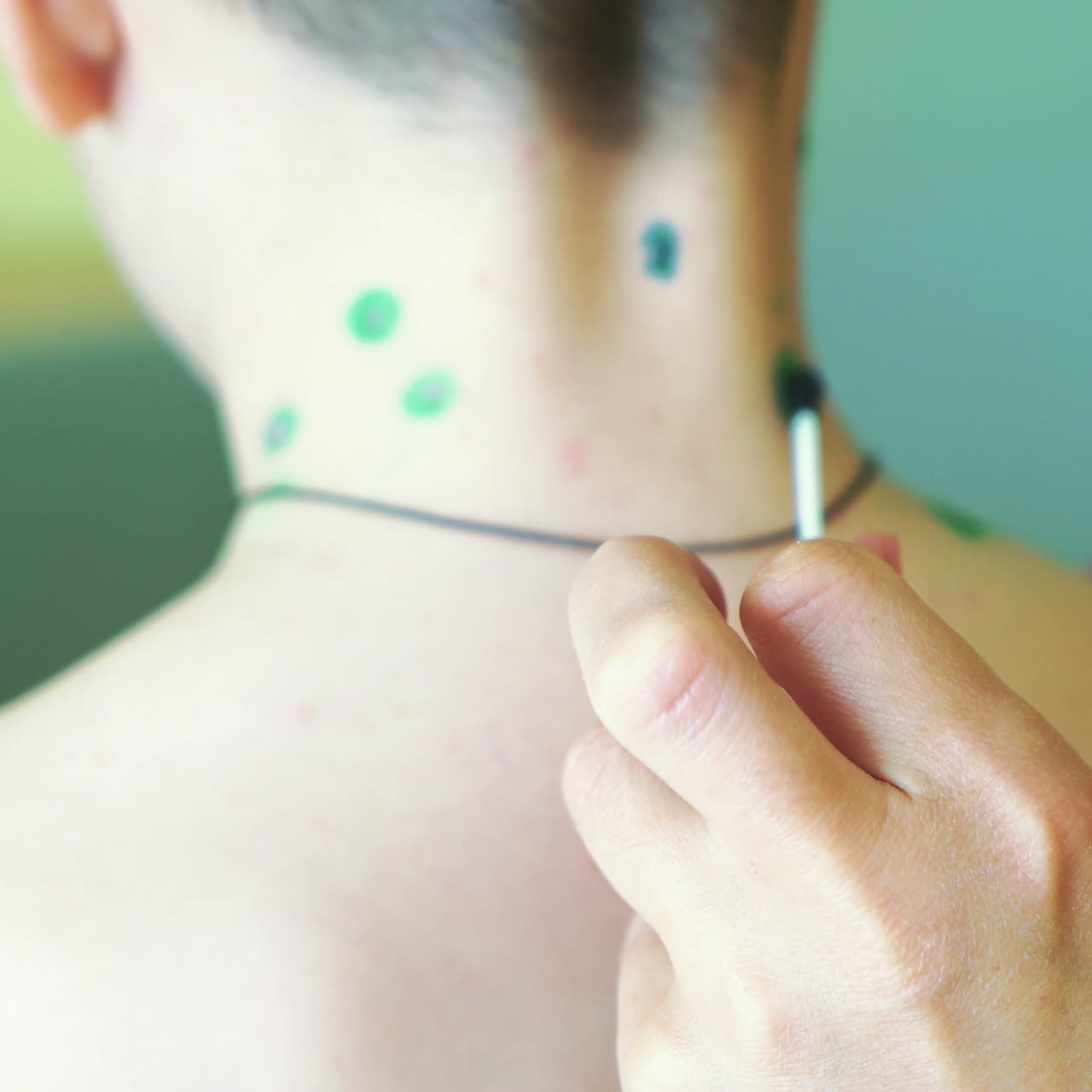 Little boy with chickenpox. Mother applying antiseptic solution to rash. Home treatment. Square video