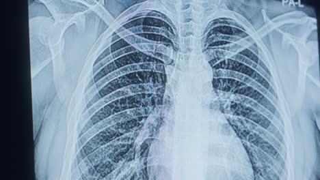 chest x-ray interpretation. medical concept. closeup