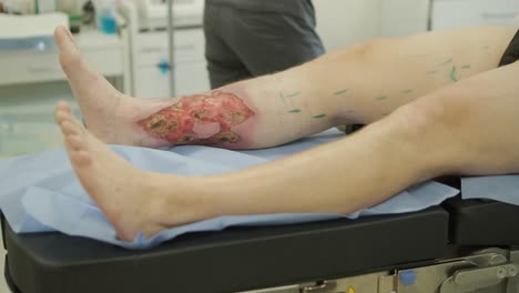 leg ulcer wound in treatment for varicose veins in phlebology procedure. bonding of veins using bioglue