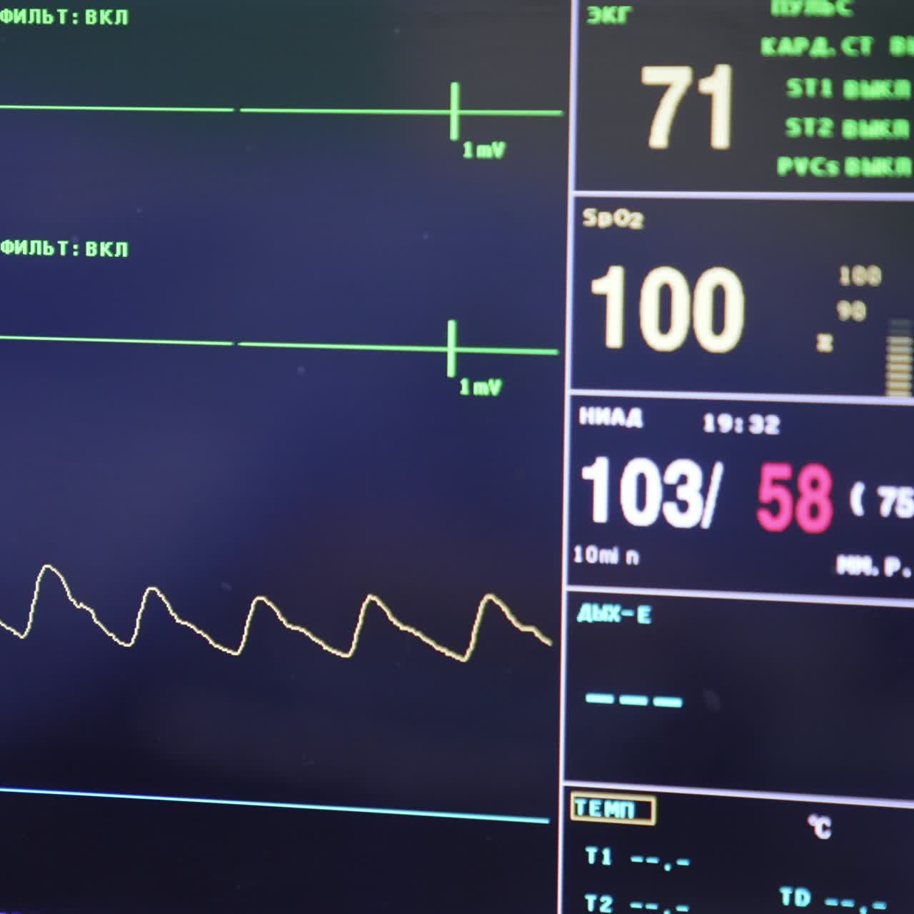 Working monitor of the medical equipment. Screen with life parameters of a patient during surgery. Close up