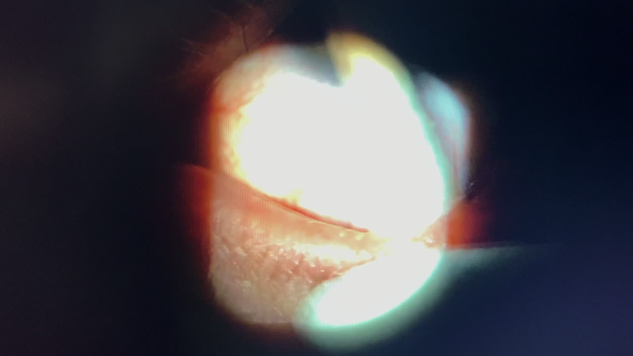 메이보미아 오일 (meibomian oil) 은 눈꺼풀의 에서 추출된 의료용 오일이다.