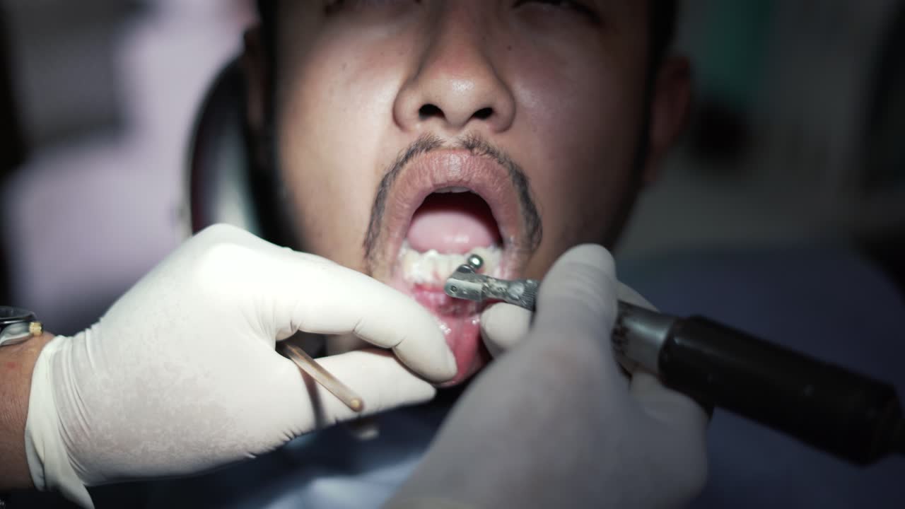 구강 예방 컵 모양의 강모가있는 외측 하단 열 연마