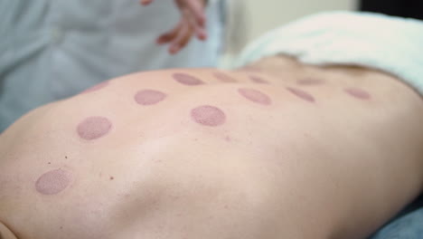 cupping therapy session