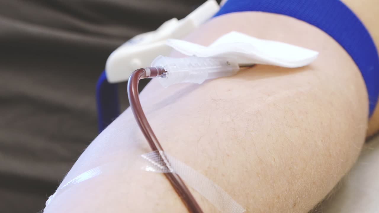 Primo piano di un donatore di sangue sdraiato su una sedia clinica con ago e tubi attaccati, che stringe una palla antistress rossa durante il processo di donazione del sangue in un ambiente medico
