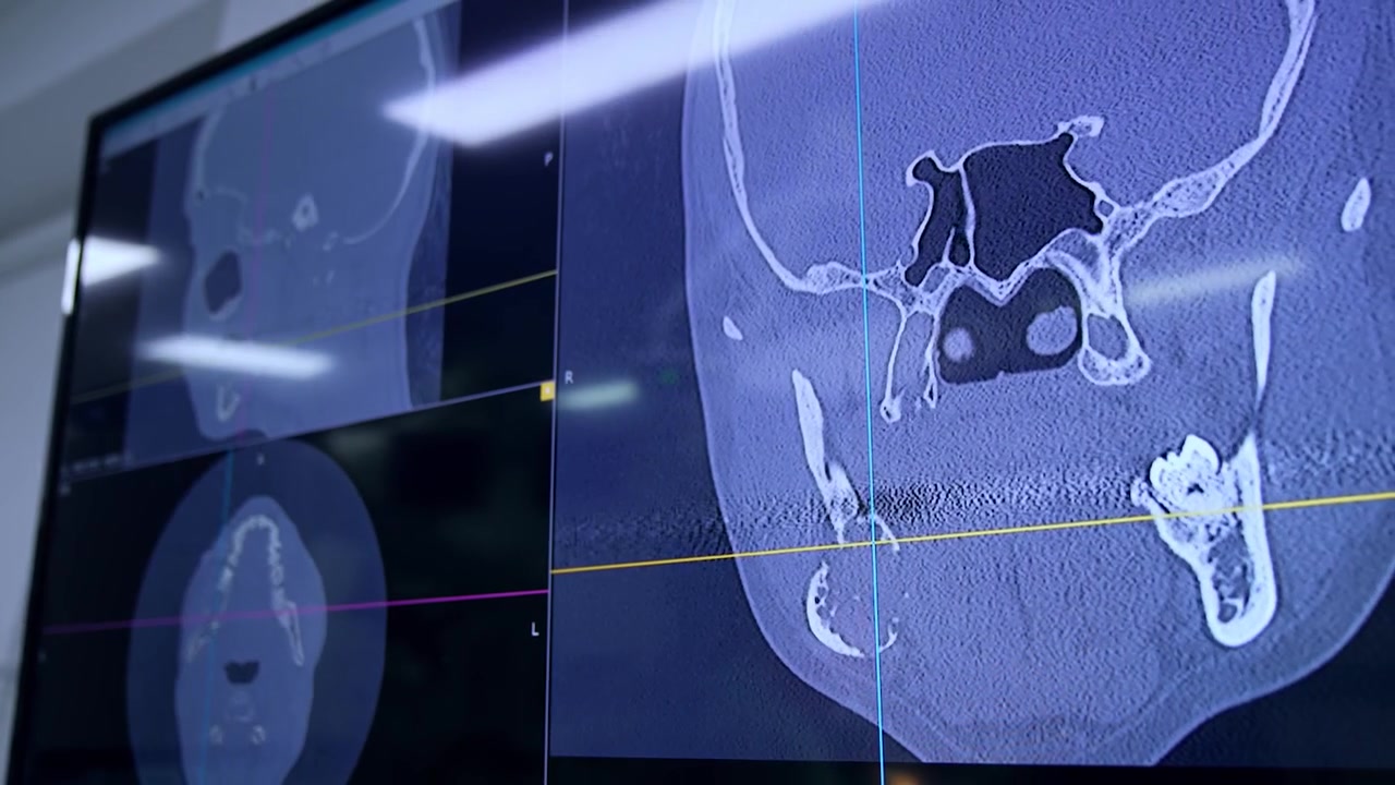 3d scanning of head on the large monitor in the surgical room. Close up. Maxillofacial operation in progress.