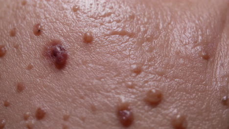 close-up of warts or skin lesions on human skin