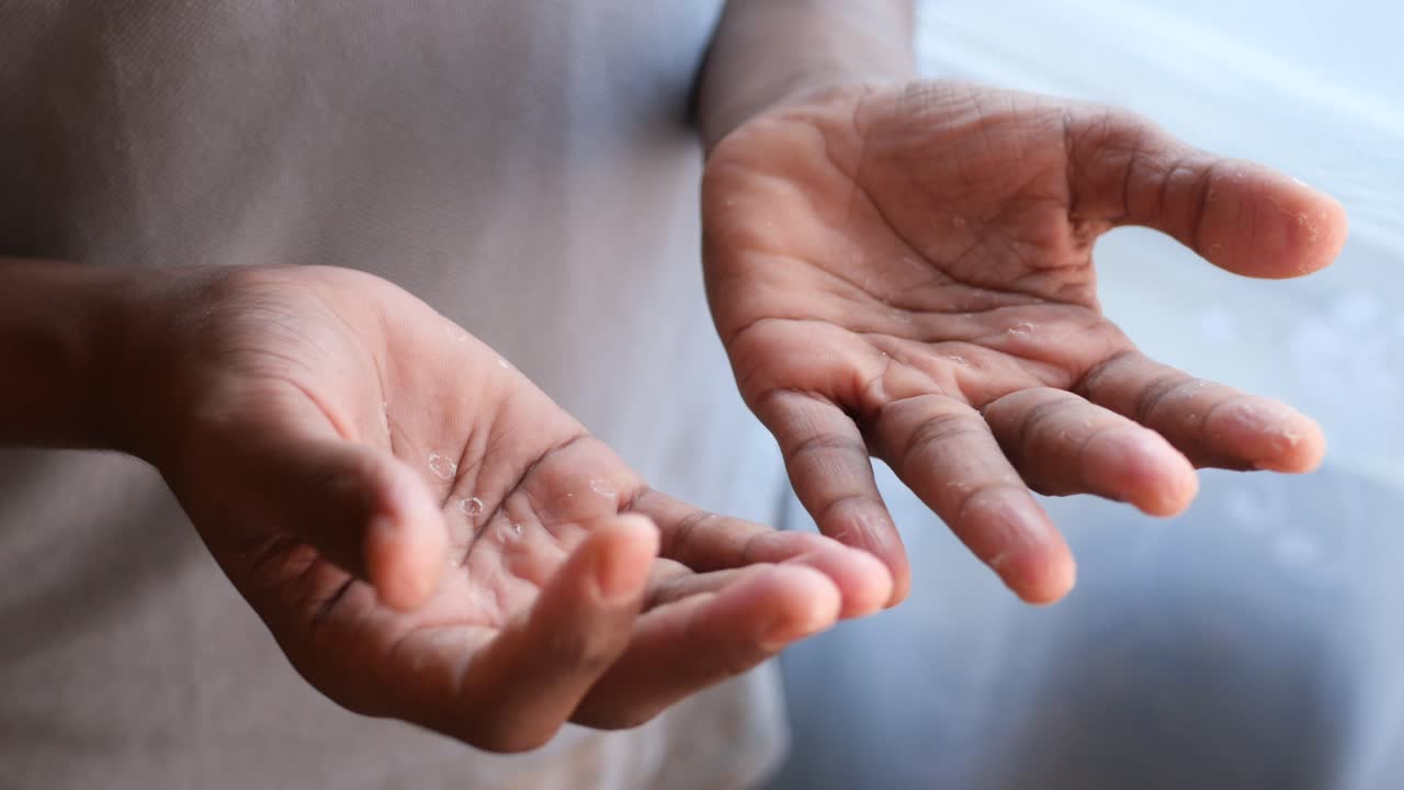 건조하고 질이 나는 손