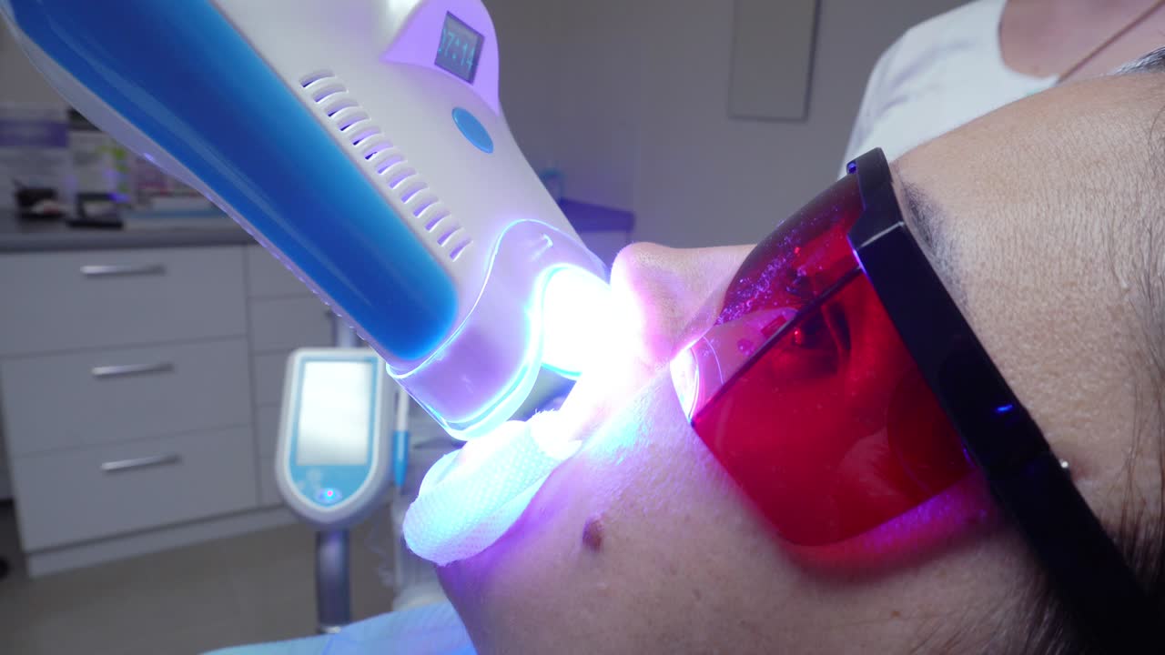 Young woman with an expander in mouth and red protective glasses getting UV whitening at the dentist's office by an ultra violet machine. Shot in 4k.