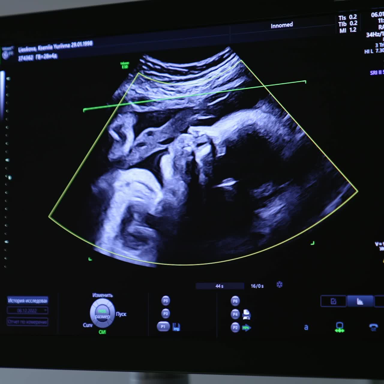 Ultrasound image of unborn baby on the black screen of equipment. The child is watched in diverse positions. Close up