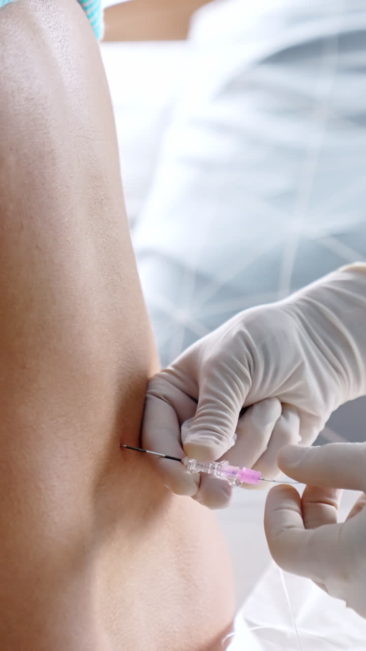 Gloved hands of a doctor giving epidural anesthesia to a patient's back. Preparation for the child birth. Vertical video