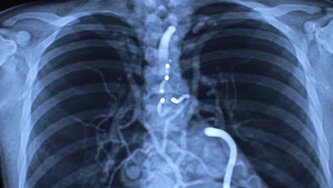 high-resolution imaging reveals chest anatomy, focusing on the intricate network of arteries and vital structures. this examination provides clarity on cardiovascular health and disease.