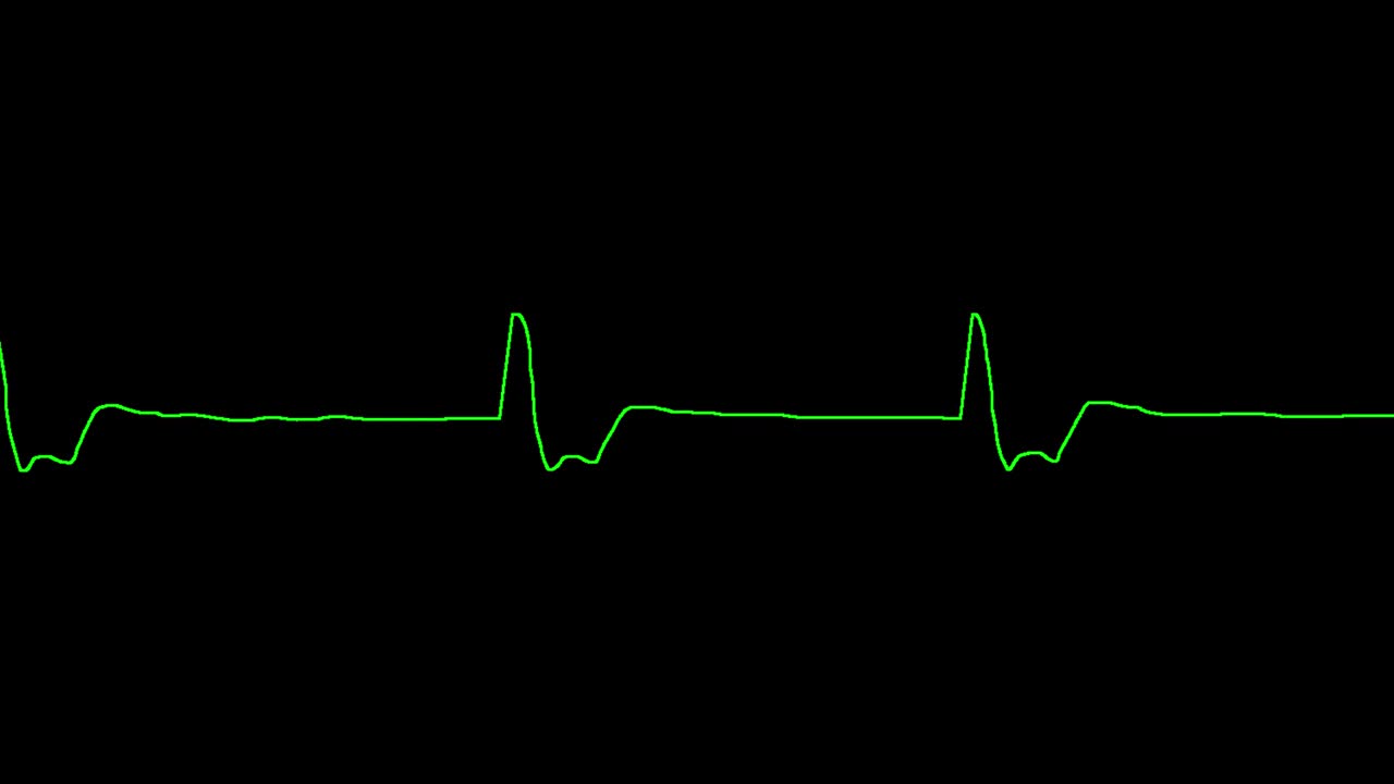 el ecg muestra arritmia idioventricular