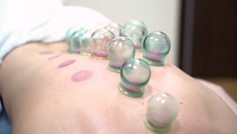 cupping therapy session on back