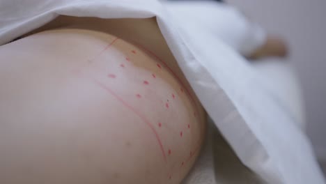 close-up of a person's body with markings for a medical or aesthetic procedure