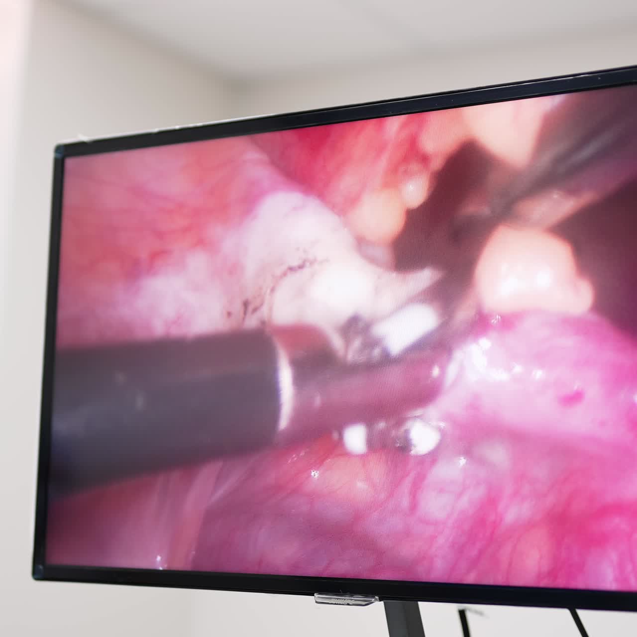 High-precise operation with the usage of modern instruments. Screen showing the surgery in process