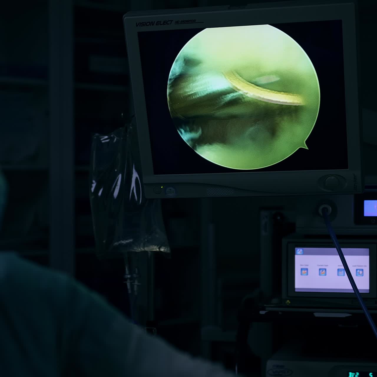 Metal tube of a tool moving among the body tissues of a patient. Monitor showing the instrument work on the macro shot of screen. Dark surgery backdrop