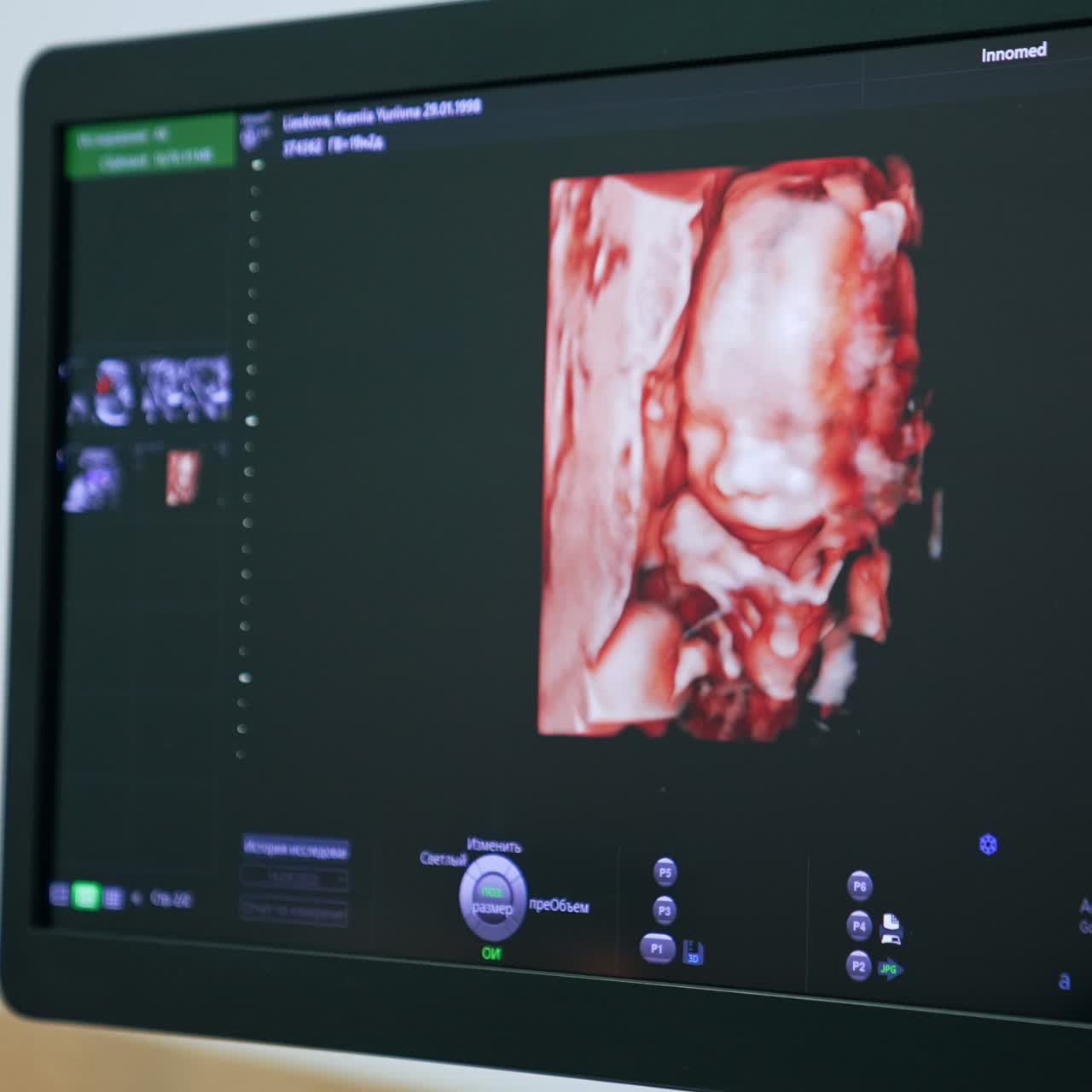 Cute baby image on the monitor of the ultrasound machine. Intrauterine development of a child