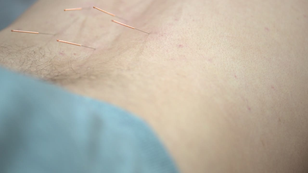 сеанс акупунктурного лечения