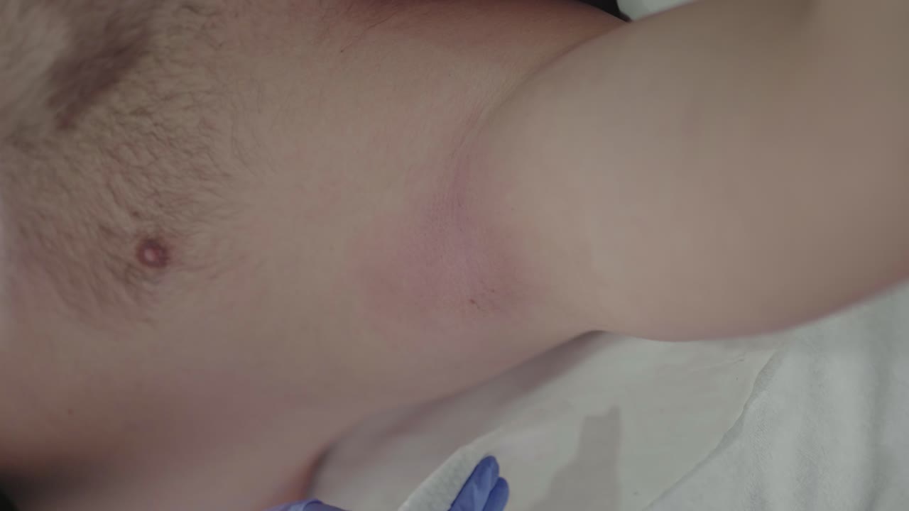 Technician wiping male armpit after laser hair removal session - vertical video