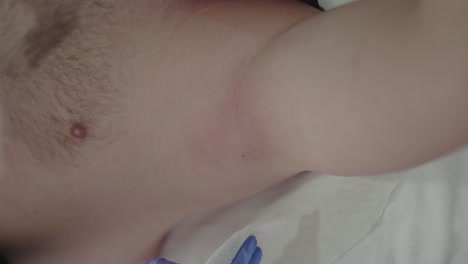technician wiping male armpit after laser hair removal session - vertical video