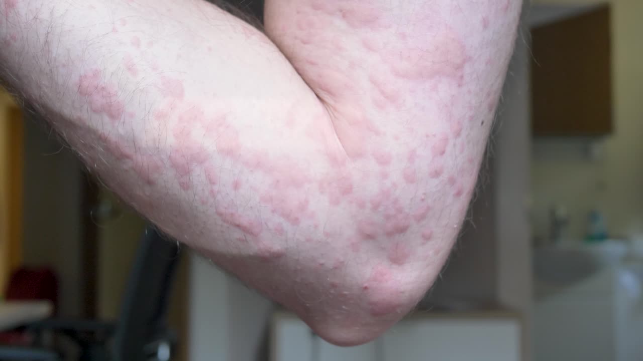 brote de urticaria en el brazo del hombre caucásico