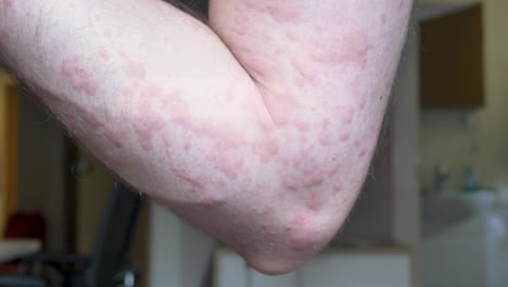 brote de urticaria en el brazo del hombre caucásico