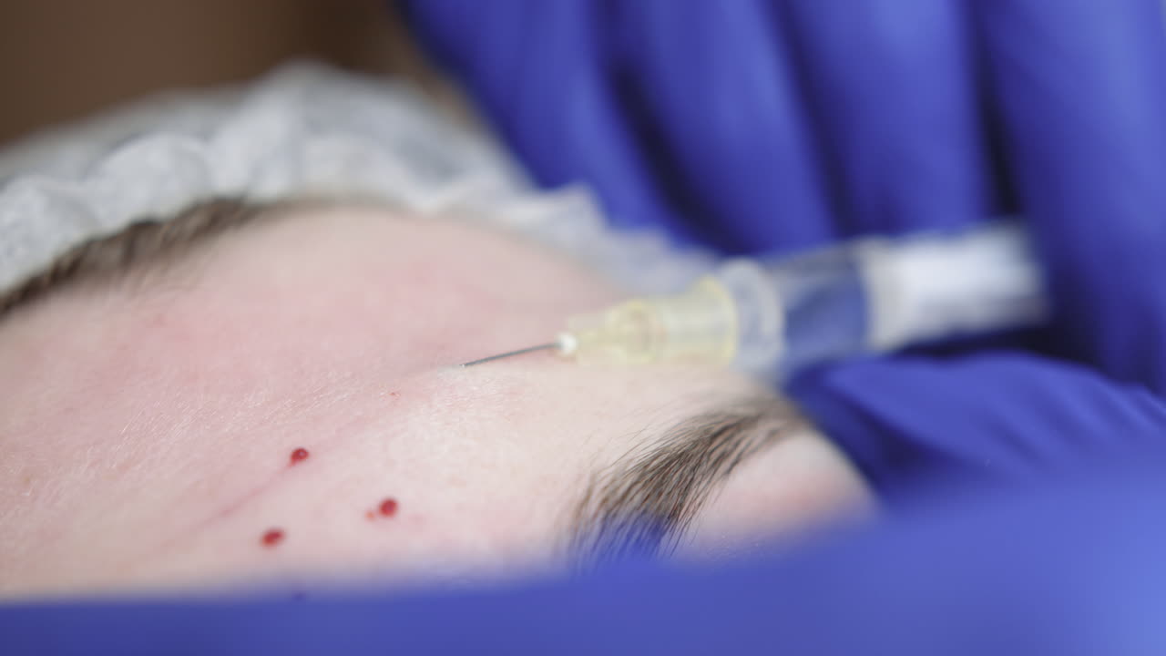 Cosmetic injection procedure on forehead | วิดีโอสต็อกแบบ พรีเมี่ยม