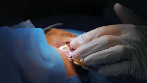 corrección de la visión con láser. un paciente y un equipo de cirujanos en la sala de operaciones durante una cirugía oftalmológica. especulo del párpado. tratamiento de lasik. paciente bajo una cubierta estéril