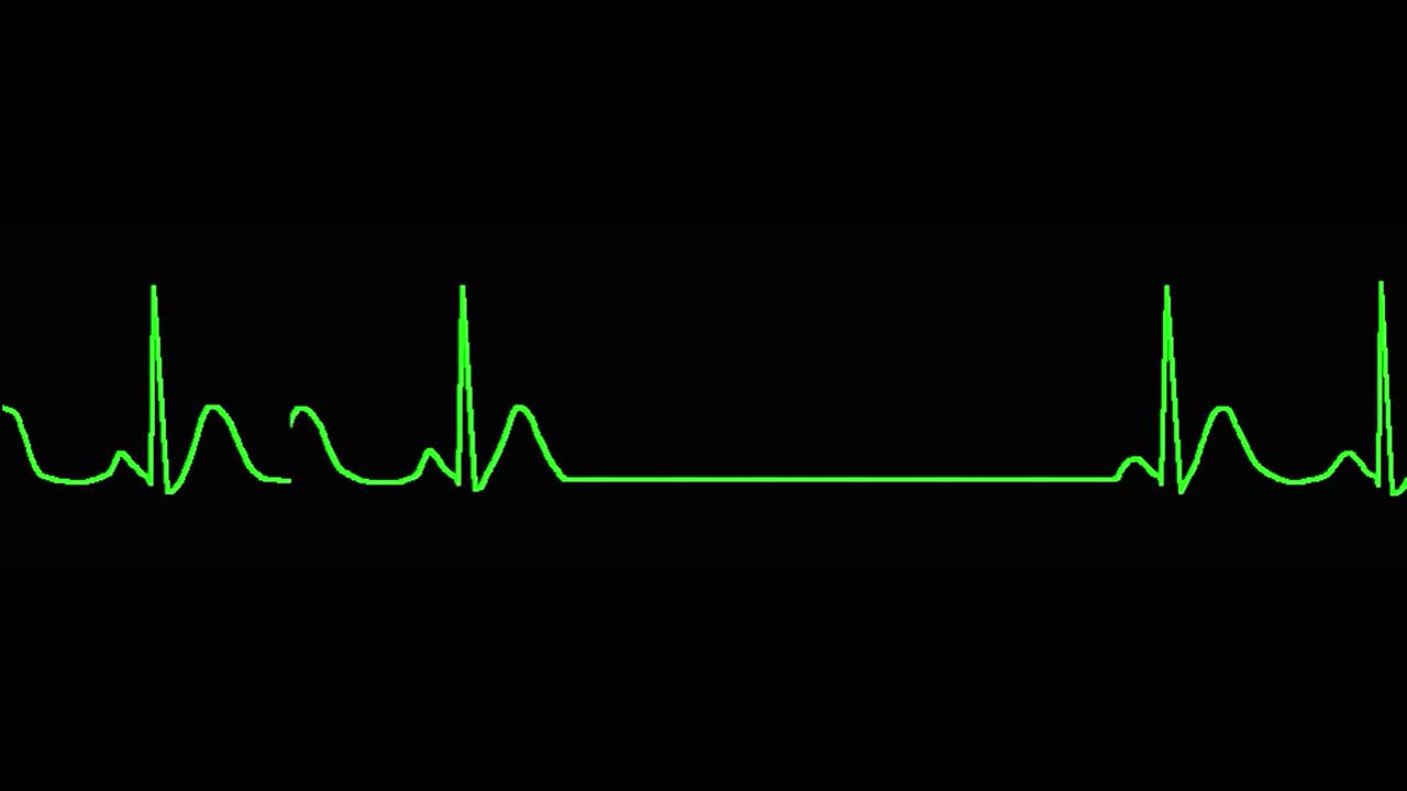 ecg는 sinus arrest를 나타니다.