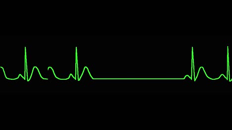 el ecg muestra un paro sinusal.
