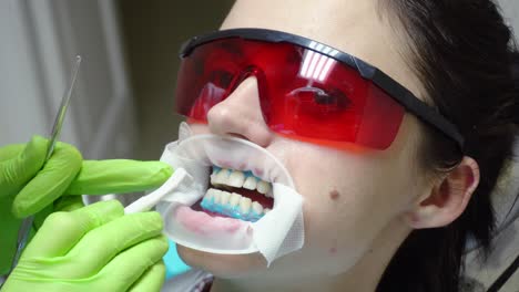 young woman with an expander in mouth at the dental clinic. application of protective whitening gel to the teeth. dentist using saliva ejector or dental pump to evacuate saliva. shot in 4k