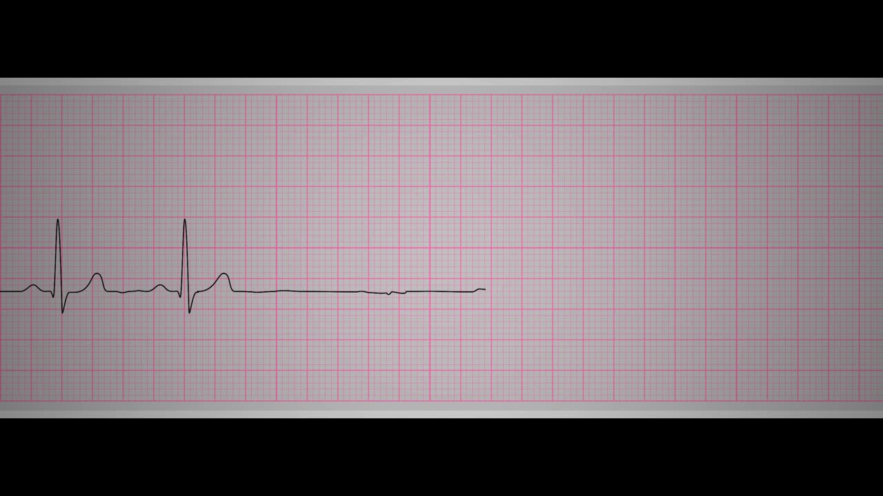 ecg (시누스 정지)