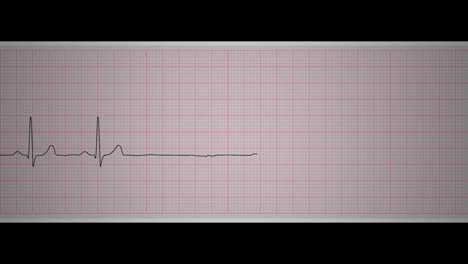 el paro sinusal del ecg