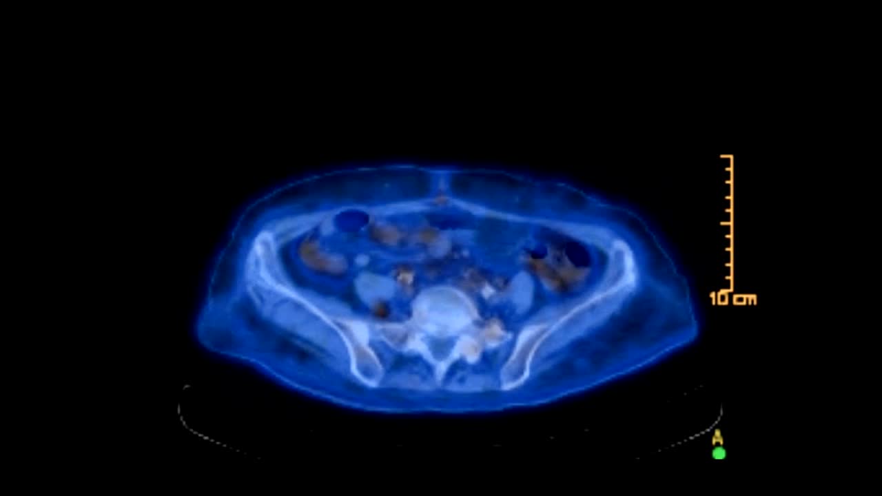 кт или позитронная эмиссионная томография всего человеческого тела для обнаружения рецидивирующей опухоли.