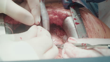 surgeons use tools grafting vessels. doctors hands carefully work on small coronary arteries with tools creating new pathway for blood flow closeup