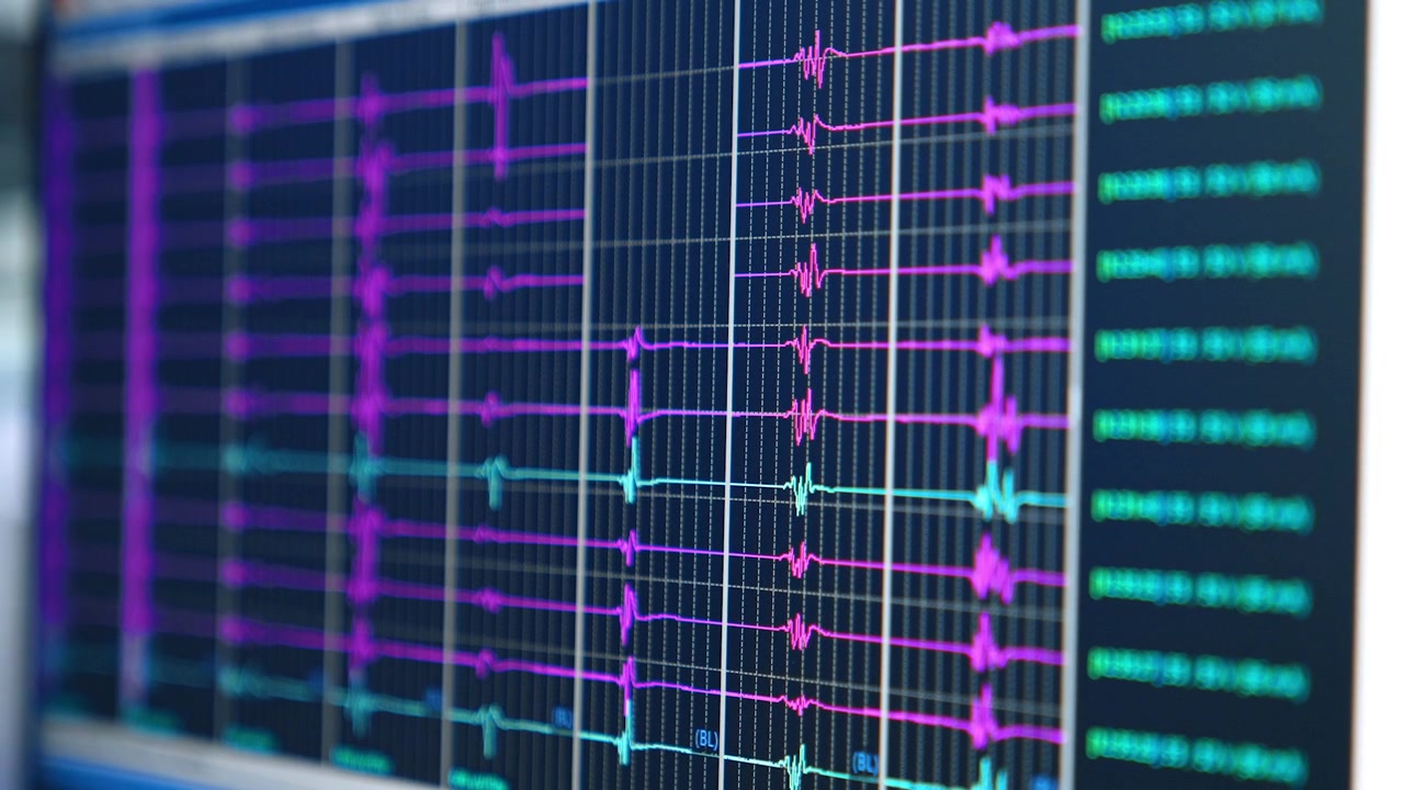 Ondas cerebrales de un paciente en el monitor de la computadora. Equipo funcionando en la sala de operaciones para procedimientos neuroquirúrgicos. Primer plano.