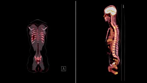 tomografía por emisión de positrones o tomografía computarizada de mascotas de todo el cuerpo humano vista coronaria y sagital para encontrar cáncer.