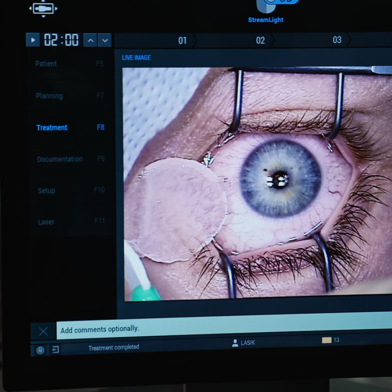 Eye laser correction in modern hospital. Ophtalmology surgery vision operation