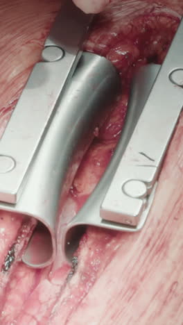 el médico utiliza un dilatador para preparar el pecho para la operación de la arteria. el cirujano prepara la arteria coronaria con una herramienta que garantiza una cirugía de derivación efectiva y resultados óptimos para el paciente en el hospital