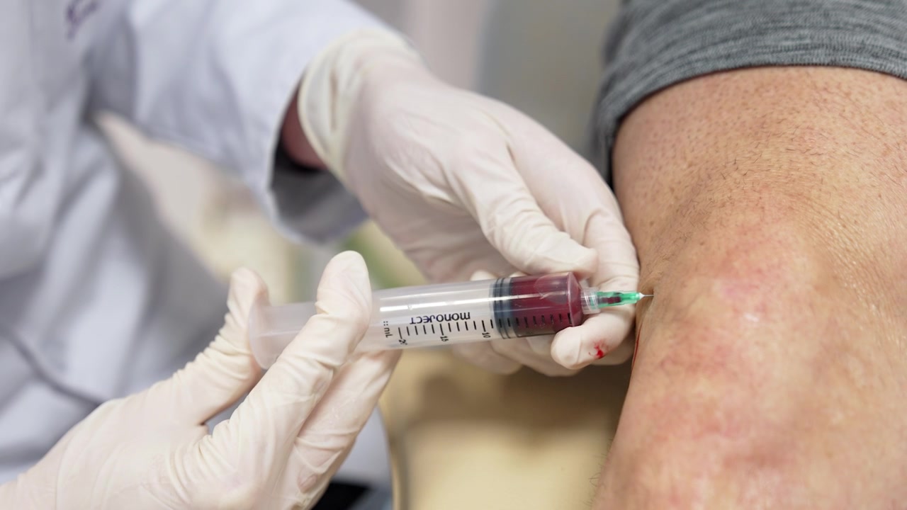 Se inyecta plasma en la rodilla del paciente. Primer plano. Ortopedia y traumatología tratadas con terapia PRP.
