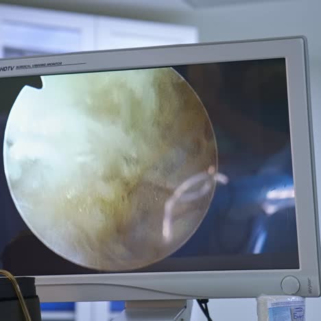 laparoscopic surgery on the monitor