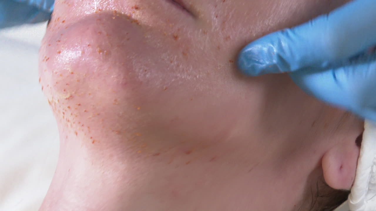 Facial Exfoliation Treatment