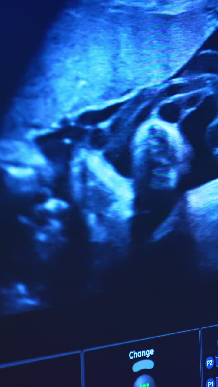 Blue monitor showing the baby movement in mother's belly. Close up. Ultrasound examination of a pregnancy. Vertical video