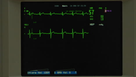 Aparece-Un-Ekg-Normal-En-Una-Pantalla