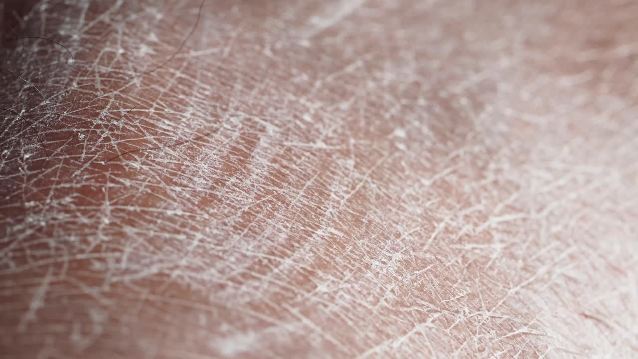 Close-up view of dry, cracked skin on a hand