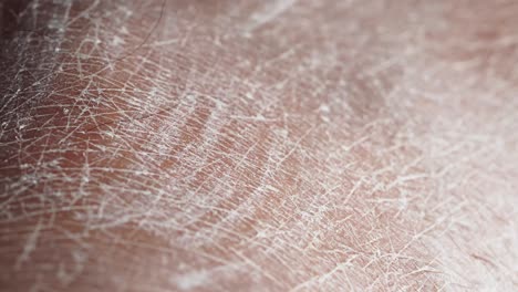 close-up view of dry, cracked skin on a hand