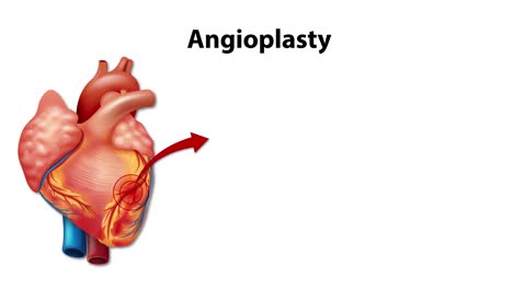 animation of balloon angioplasty in coronary artery