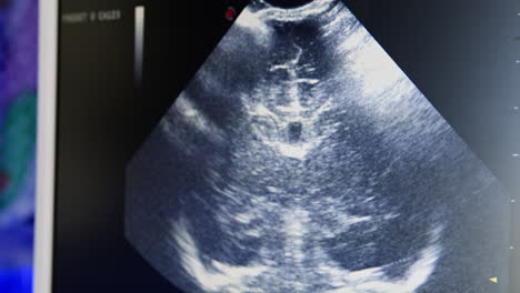 liver ultrasound scan