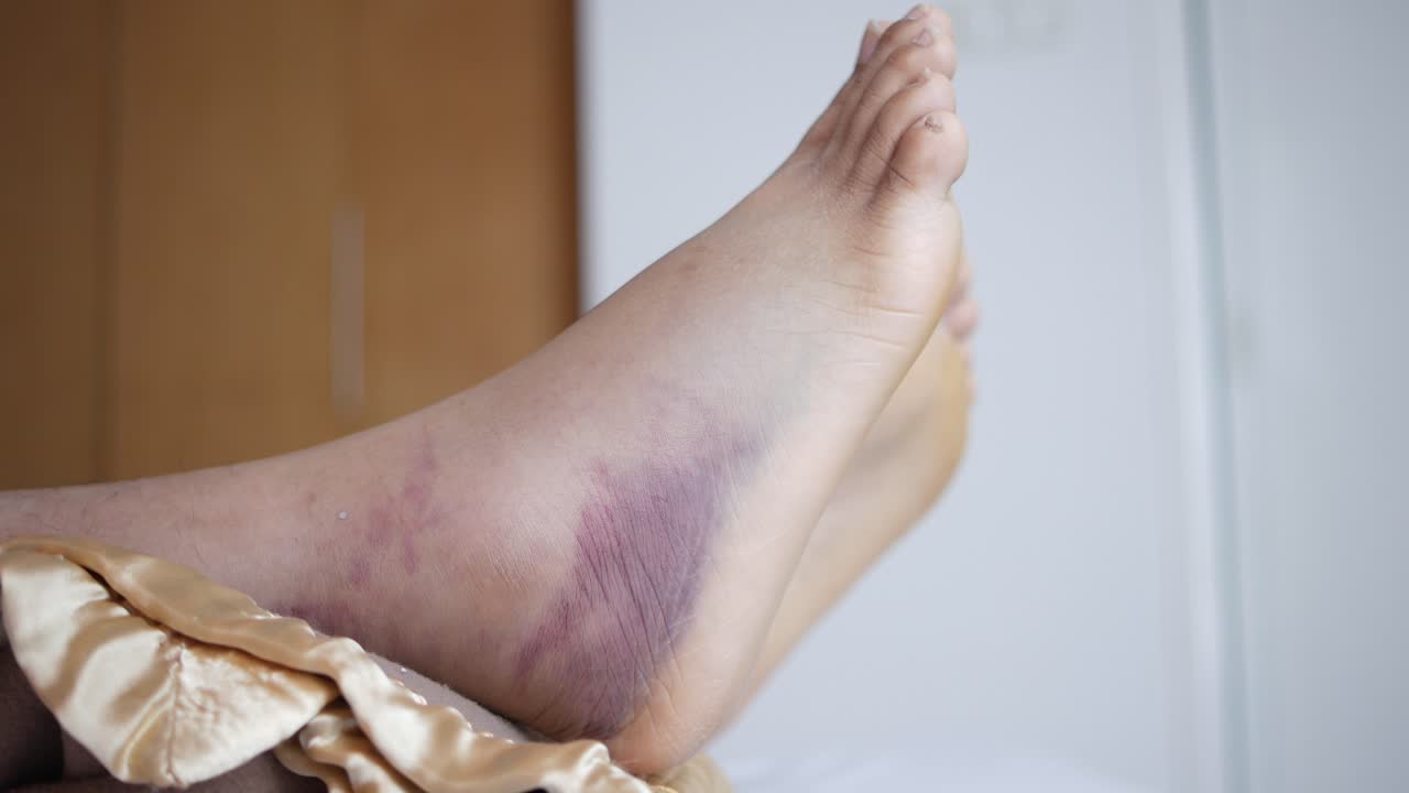 Severely Bruised and Swollen Ankle